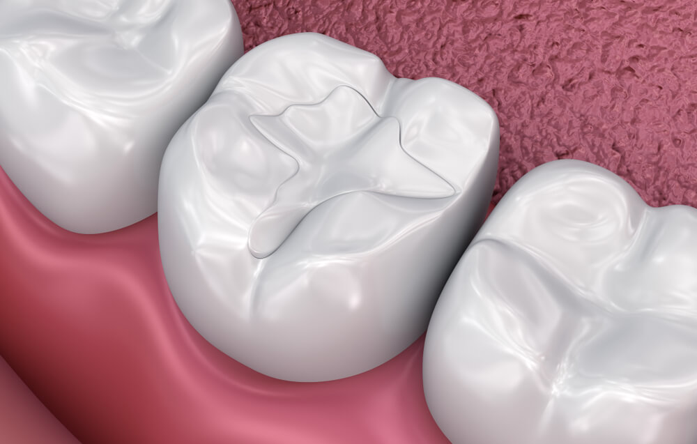 dental filling on teeth