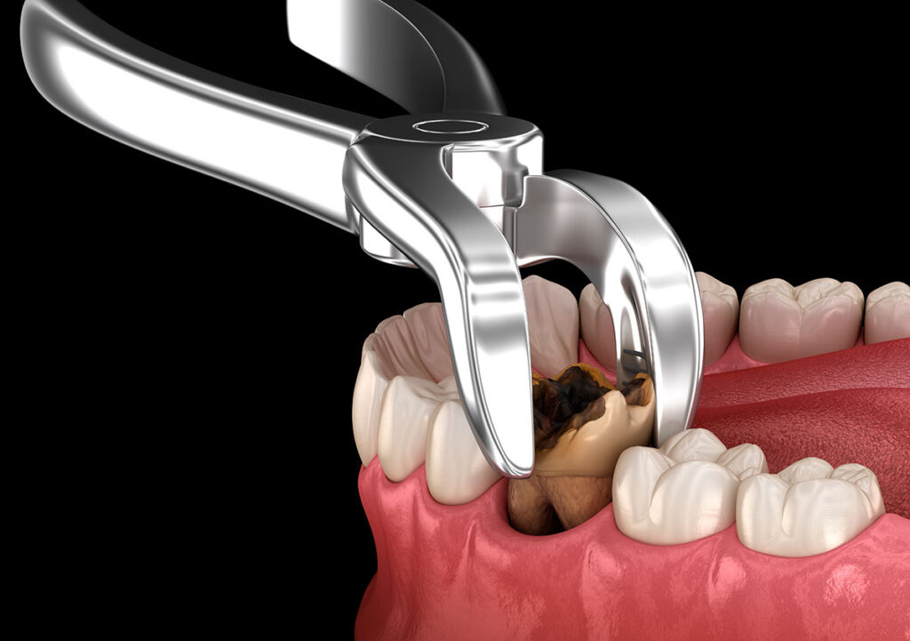 getting a tooth extraction miami fl